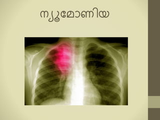 നയൂകൈോണിയ
 