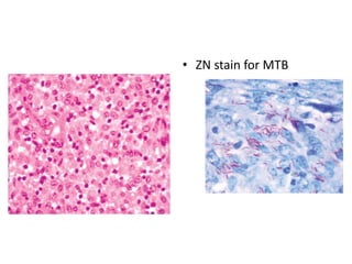 Mycobacterium avium complex
• ZN stain for MTB
 