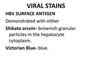 VIRAL STAINS
HBV SURFACE ANTIGEN
Demonstrated with either
Shikata orcein- brownish granular
particles in the hepatocyte
cytoplasm.
Victorian Blue- blue.
 