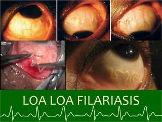 LOA LOA FILARIASIS
 