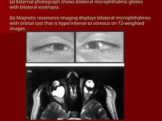 Microphthalmic Microphthalmos and Nanophthalmos - eyerounds.org.ppt