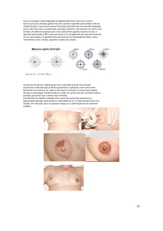 Para se conseguir o efeito degradeé da pigmentação (halo mais claro e centro
mais escuro) será utilizada agulha linear de 5 pontas e aparelho posicionado a 45º em
relação da pele, o que levará a pintura da aréola, partindo com uma pressão moderada
para o halo mais claro e aumentando a pressão conforme ir de encontro ao centro. Para
se obter um efeito de projeção para o bico utilizaremos agulhas triponta circular, e
aparelho posicionado a 90º o que escurecerá a cor do pigmento sem que este necessite
de um novo preparo. O aparelho deve permanecer em velocidade de média a alta e
movimentos curtos e lentos, seguindo o trajeto das aréolas.
Ao término da técnica a higienização local e aplicação local de uma pomada
cicatrizante é indicada após os 08 dias posteriores a aplicação, assim como evitar
banhos de mar e piscina, sol, vapor e não coçar ou remover as crostas que surgirão
durante a cicatrização, Também pode ser usado um curativo do tipo micropore sobre a
pomada, para evitar que a mesma seja removida.
A verificação do trabalho realizado será a partir dos quinze dias posteriores a
pigmentação aplicada, observando-se a densidade da cor. A cliente deverá fazer uma
revisão. Um mês após, para um possível retoque ou a confirmação de um excelente
trabalho.
23
 
