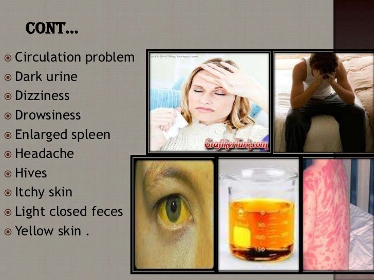 Dark Urine And Heavy Alcohol Drinking Dark Urine And Heavy Alcohol Drinking