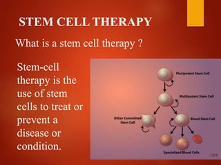 STEM CELL THERAPY
What is a stem cell therapy ?
Stem-cell
therapy is the
use of stem
cells to treat or
prevent a
disease or
condition.
 