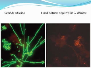 Candida albicans Blood cultures negative for C. albicans
 
