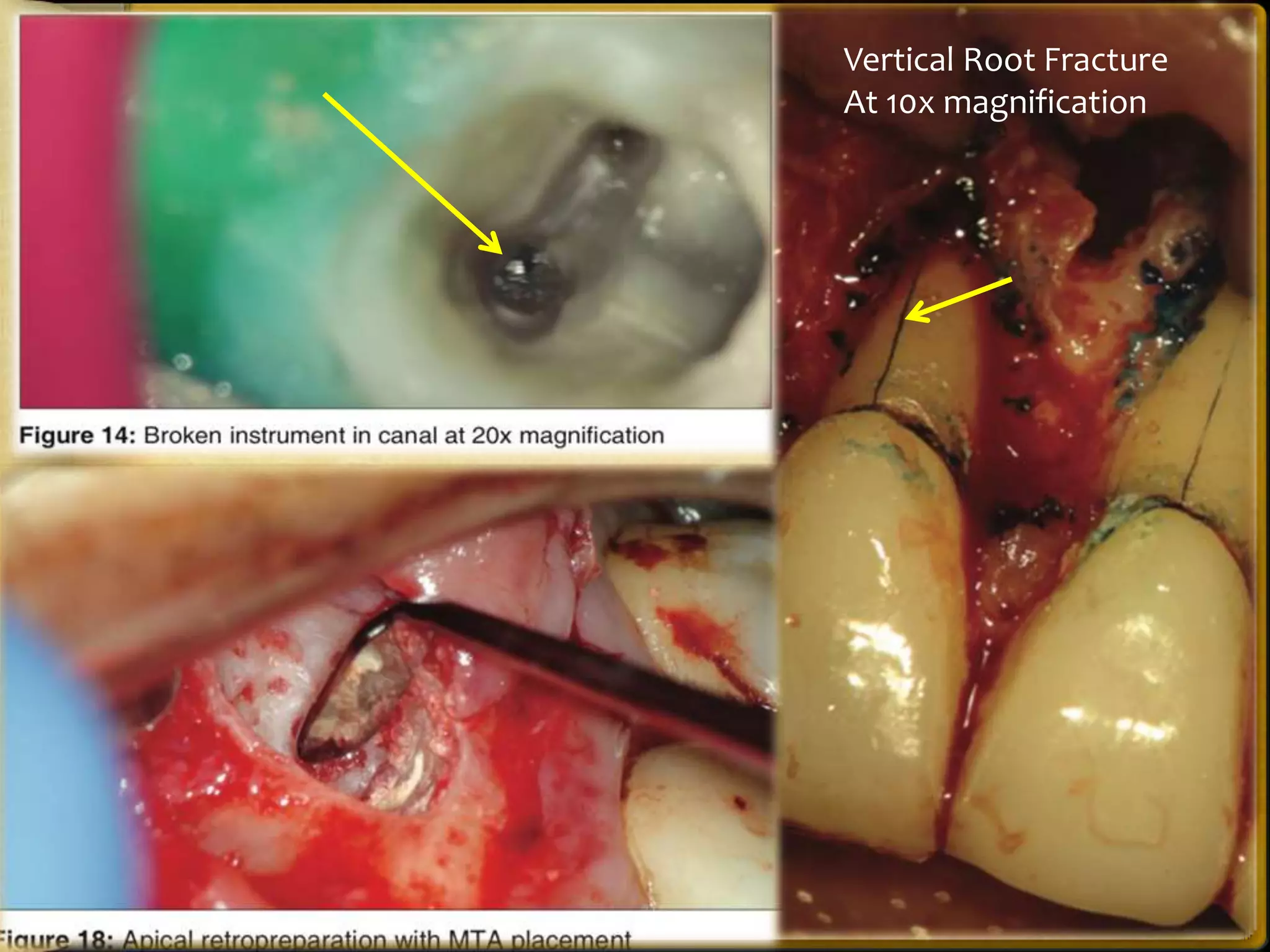 Vertical Root Fracture
At 10x magnification
 