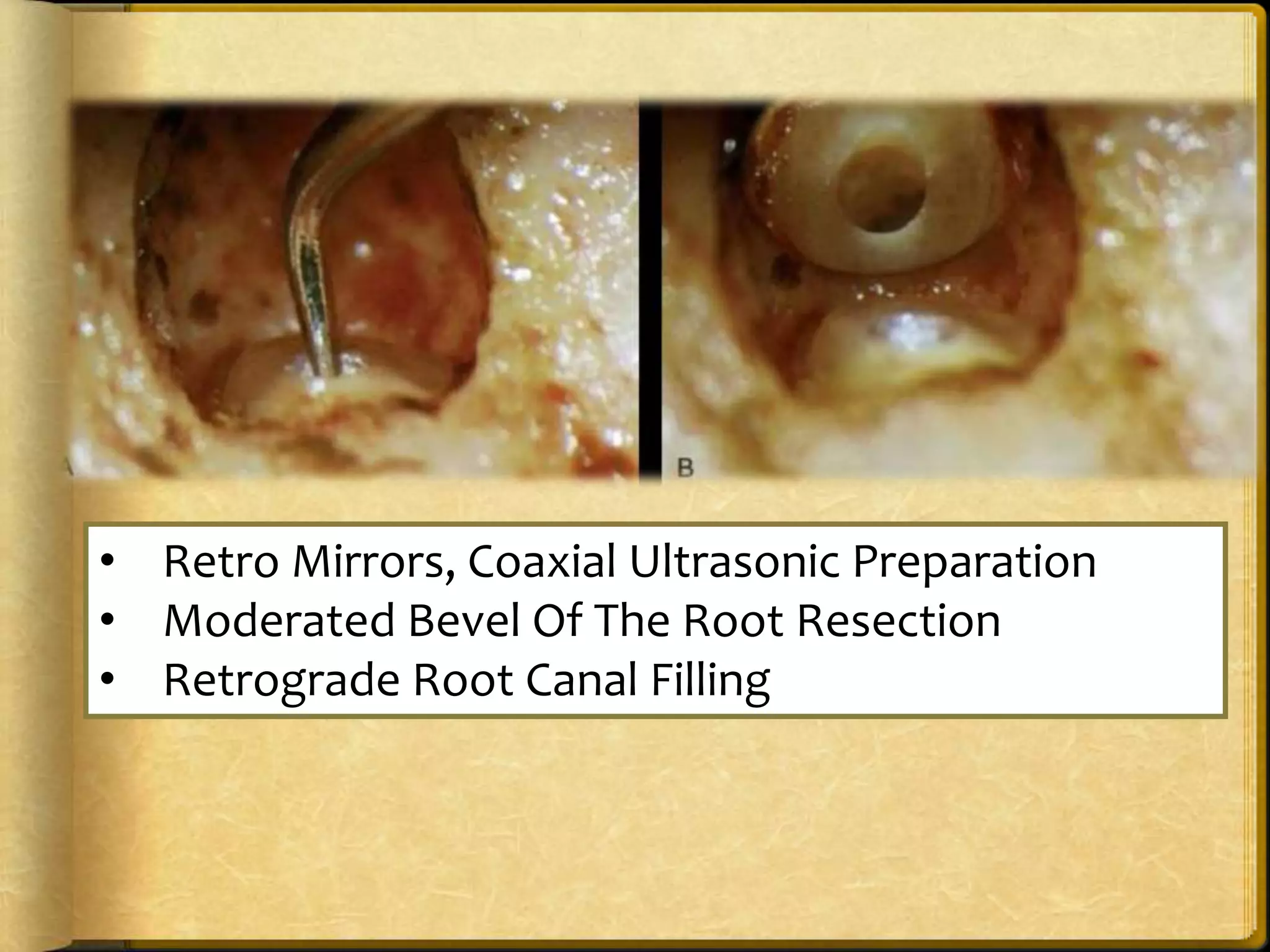 • Retro Mirrors, Coaxial Ultrasonic Preparation
• Moderated Bevel Of The Root Resection
• Retrograde Root Canal Filling
 