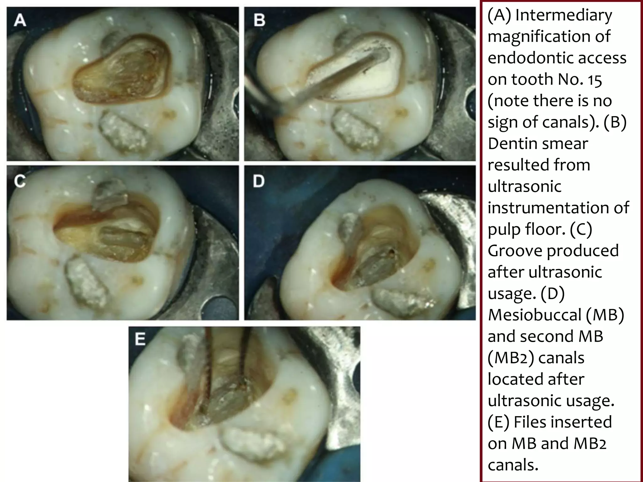 (A) Intermediary
magnification of
endodontic access
on tooth No. 15
(note there is no
sign of canals). (B)
Dentin smear
resulted from
ultrasonic
instrumentation of
pulp floor. (C)
Groove produced
after ultrasonic
usage. (D)
Mesiobuccal (MB)
and second MB
(MB2) canals
located after
ultrasonic usage.
(E) Files inserted
on MB and MB2
canals.
 