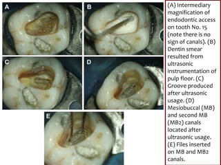 (A) Intermediary
magnification of
endodontic access
on tooth No. 15
(note there is no
sign of canals). (B)
Dentin smear
resulted from
ultrasonic
instrumentation of
pulp floor. (C)
Groove produced
after ultrasonic
usage. (D)
Mesiobuccal (MB)
and second MB
(MB2) canals
located after
ultrasonic usage.
(E) Files inserted
on MB and MB2
canals.
 