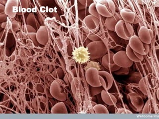 Blood Clot
 