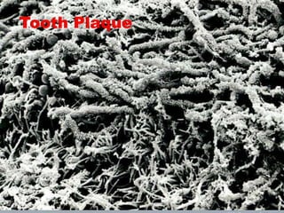 Tooth Plaque
 