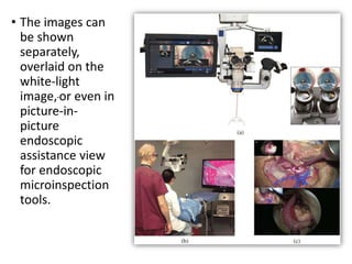 • The images can
be shown
separately,
overlaid on the
white-light
image,or even in
picture-in-
picture
endoscopic
assistance view
for endoscopic
microinspection
tools.
 