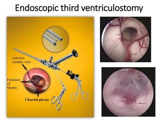 Endoscopic third ventriculostomy
 