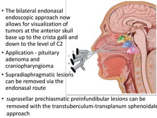 • The bilateral endonasal
endoscopic approach now
allows for visualization of
tumors at the anterior skull
base up to the crista galli and
down to the level of C2
• Application - pituitary
adenoma and
craniopharyngioma
• Supradiaphragmatic lesions
can be removed via the
endonasal route
• suprasellar prechiasmatic preinfundibular lesions can be
removed with the transtuberculum-transplanum sphenoidale
approach
 