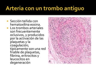  Sección teñida con
hematoxilina eosina.
 Los trombos arteriales
son frecuentemente
oclusivos, y producidos
por la activación de las
plaquetas y la
coagulación;
típicamente son una red
friable de plaquetas,
fibrina, eritrocitos y
leucocitos en
degeneración
 