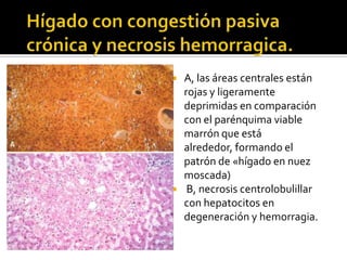 A, las áreas centrales están
rojas y ligeramente
deprimidas en comparación
con el parénquima viable
marrón que está
alrededor, formando el
patrón de «hígado en nuez
moscada)
 B, necrosis centrolobulillar
con hepatocitos en
degeneración y hemorragia.
 