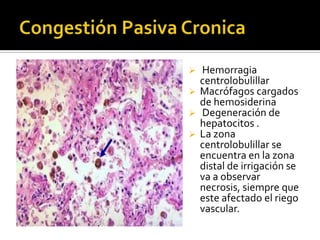  Hemorragia
centrolobulillar
 Macrófagos cargados
de hemosiderina
 Degeneración de
hepatocitos .
 La zona
centrolobulillar se
encuentra en la zona
distal de irrigación se
va a observar
necrosis, siempre que
este afectado el riego
vascular.
 