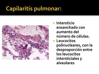  Intersticio
ensanchado con
aumento del
número de células.
 Leucocitos
polinucleares, con la
desproporción entre
los leucocitos
intersticiales y
alveolares
 