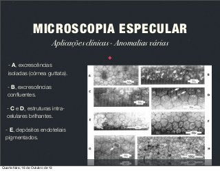 MICROSCOPIA ESPECULAR
Aplicações clínicas - Anomalias várias
- A, excrescências
isoladas (córnea guttata).
- B, excrescências
conﬂuentes.
- C e D, estruturas intracelulares brilhantes.
- E, depósitos endoteliais
pigmentados.

Quarta-feira, 16 de Outubro de 13

 