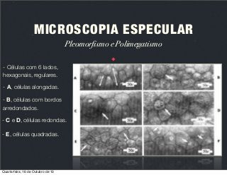MICROSCOPIA ESPECULAR
Pleomorfismo e Polimegatismo
- Células com 6 lados,
hexagonais, regulares.
- A, células alongadas.
- B, células com bordos
arredondados.
- C e D, células redondas.
- E, células quadradas.

Quarta-feira, 16 de Outubro de 13

 
