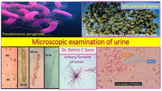 Dr. Rohini C Sane
Microscopic examination of urine
Urinary Tyrosine
crystals
Uric acid renal stones
Pseudomonas aeruginosa
 