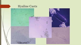 Hyaline Casts
 
