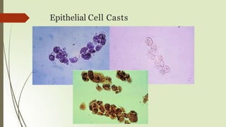 Epithelial Cell Casts
 