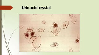 Uricacid crystal
 