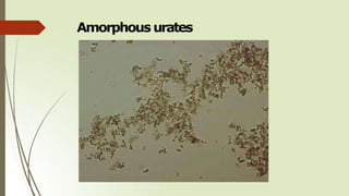 Amorphous urates
 