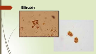 Bilirubin
 