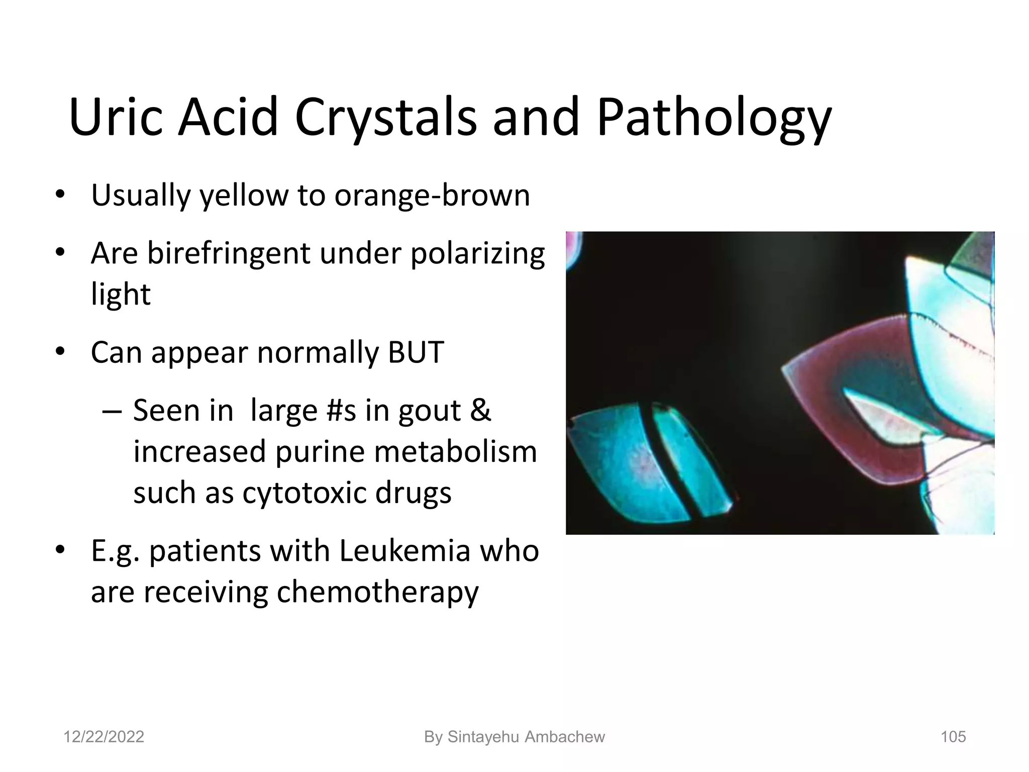 105
Uric Acid Crystals and Pathology
• Usually yellow to orange-brown
• Are birefringent under polarizing
light
• Can appear normally BUT
– Seen in large #s in gout &
increased purine metabolism
such as cytotoxic drugs
• E.g. patients with Leukemia who
are receiving chemotherapy
12/22/2022 By Sintayehu Ambachew
 