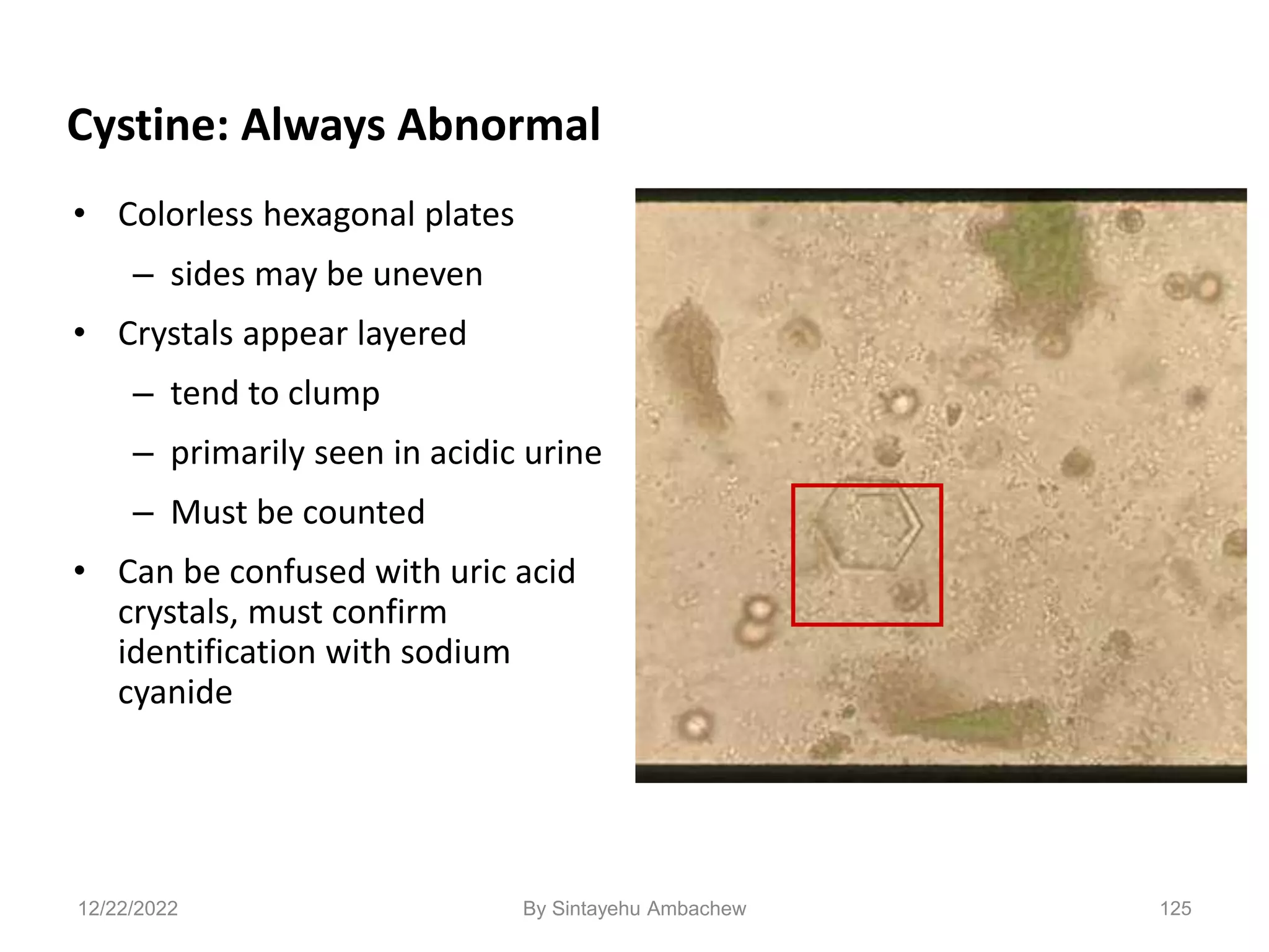 125
Cystine: Always Abnormal
• Colorless hexagonal plates
– sides may be uneven
• Crystals appear layered
– tend to clump
– primarily seen in acidic urine
– Must be counted
• Can be confused with uric acid
crystals, must confirm
identification with sodium
cyanide
12/22/2022 By Sintayehu Ambachew
 