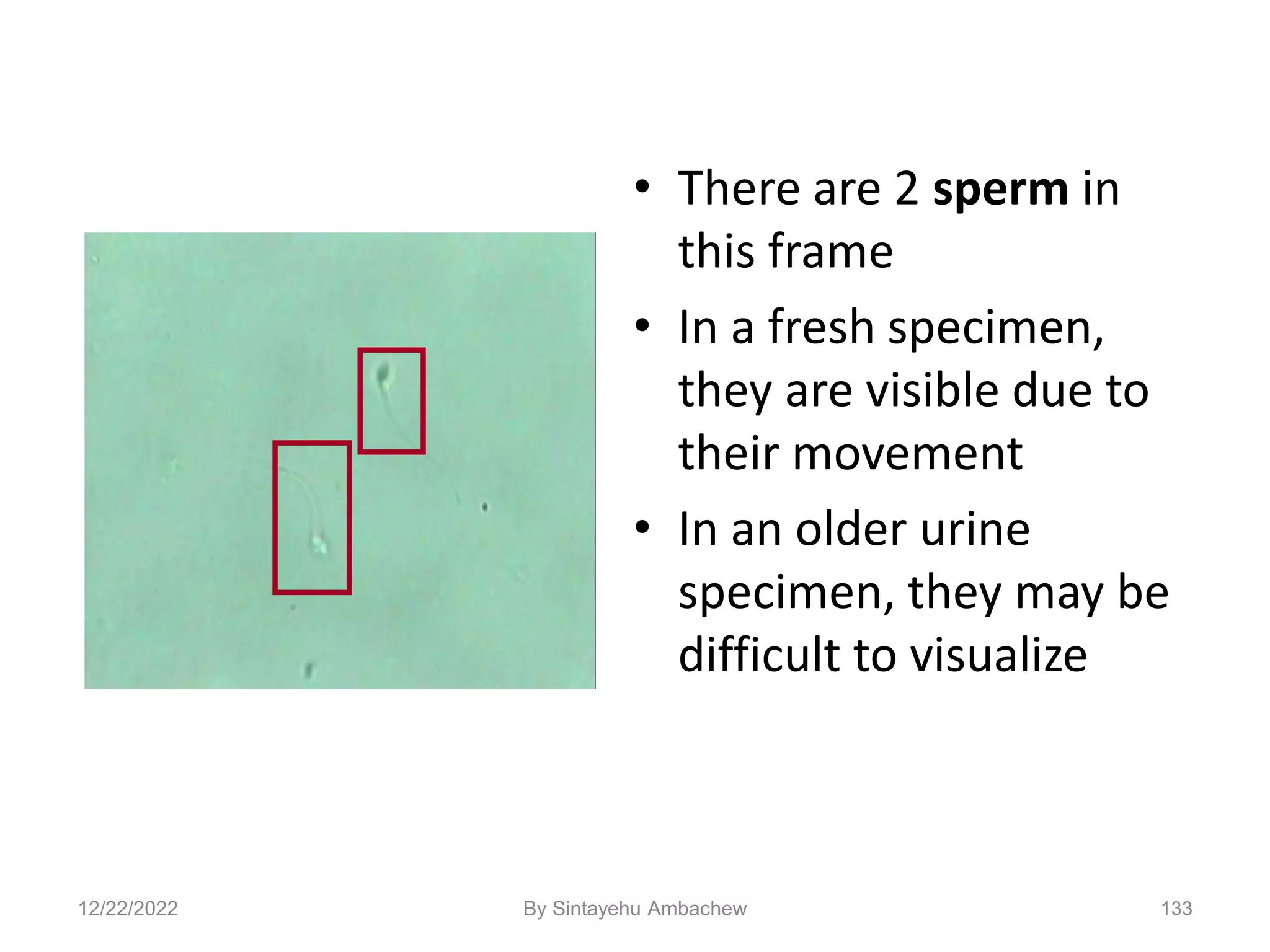 133
• There are 2 sperm in
this frame
• In a fresh specimen,
they are visible due to
their movement
• In an older urine
specimen, they may be
difficult to visualize
12/22/2022 By Sintayehu Ambachew
 