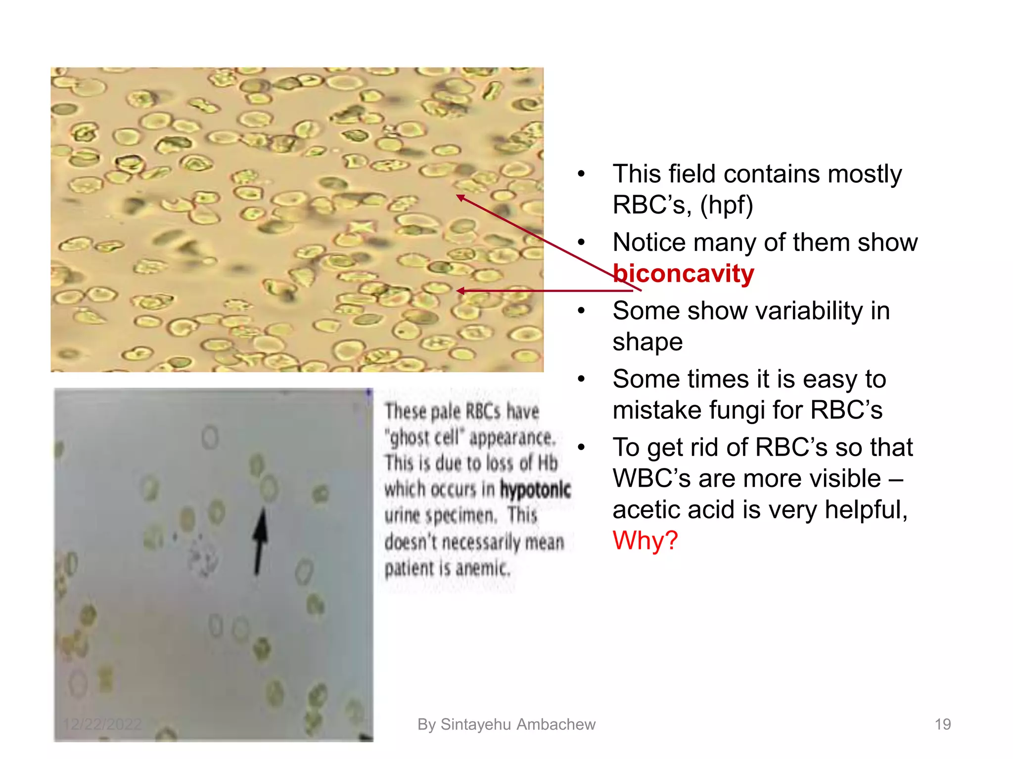 19
• This field contains mostly
RBC’s, (hpf)
• Notice many of them show
biconcavity
• Some show variability in
shape
• Some times it is easy to
mistake fungi for RBC’s
• To get rid of RBC’s so that
WBC’s are more visible –
acetic acid is very helpful,
Why?
12/22/2022 By Sintayehu Ambachew
 