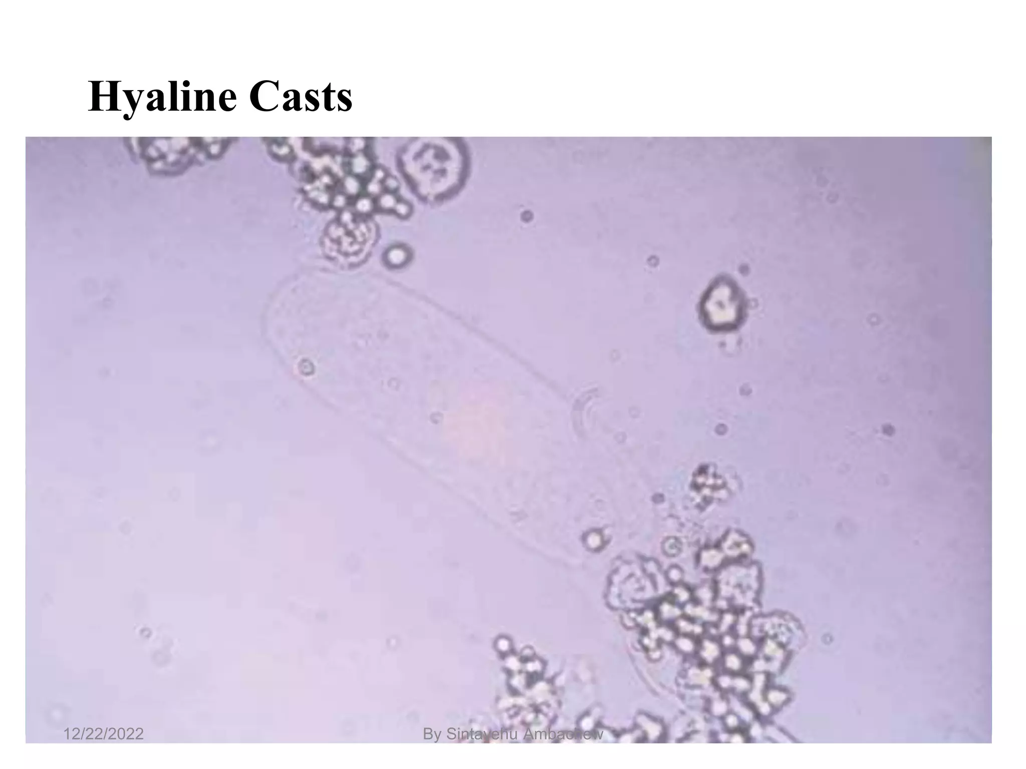 Hyaline Casts
50
12/22/2022 By Sintayehu Ambachew
 
