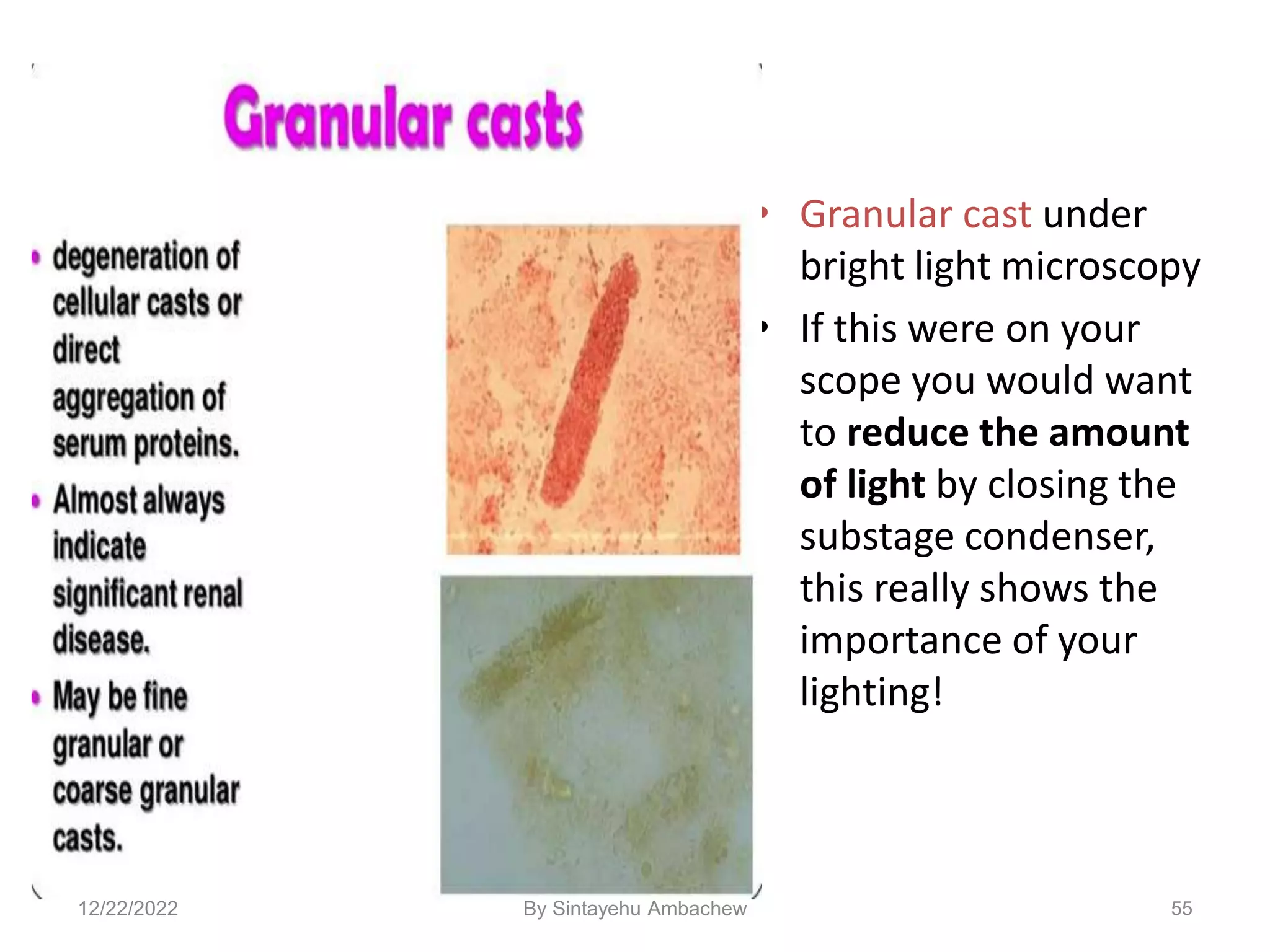 • Granular cast under
bright light microscopy
• If this were on your
scope you would want
to reduce the amount
of light by closing the
substage condenser,
this really shows the
importance of your
lighting!
55
12/22/2022 By Sintayehu Ambachew
 