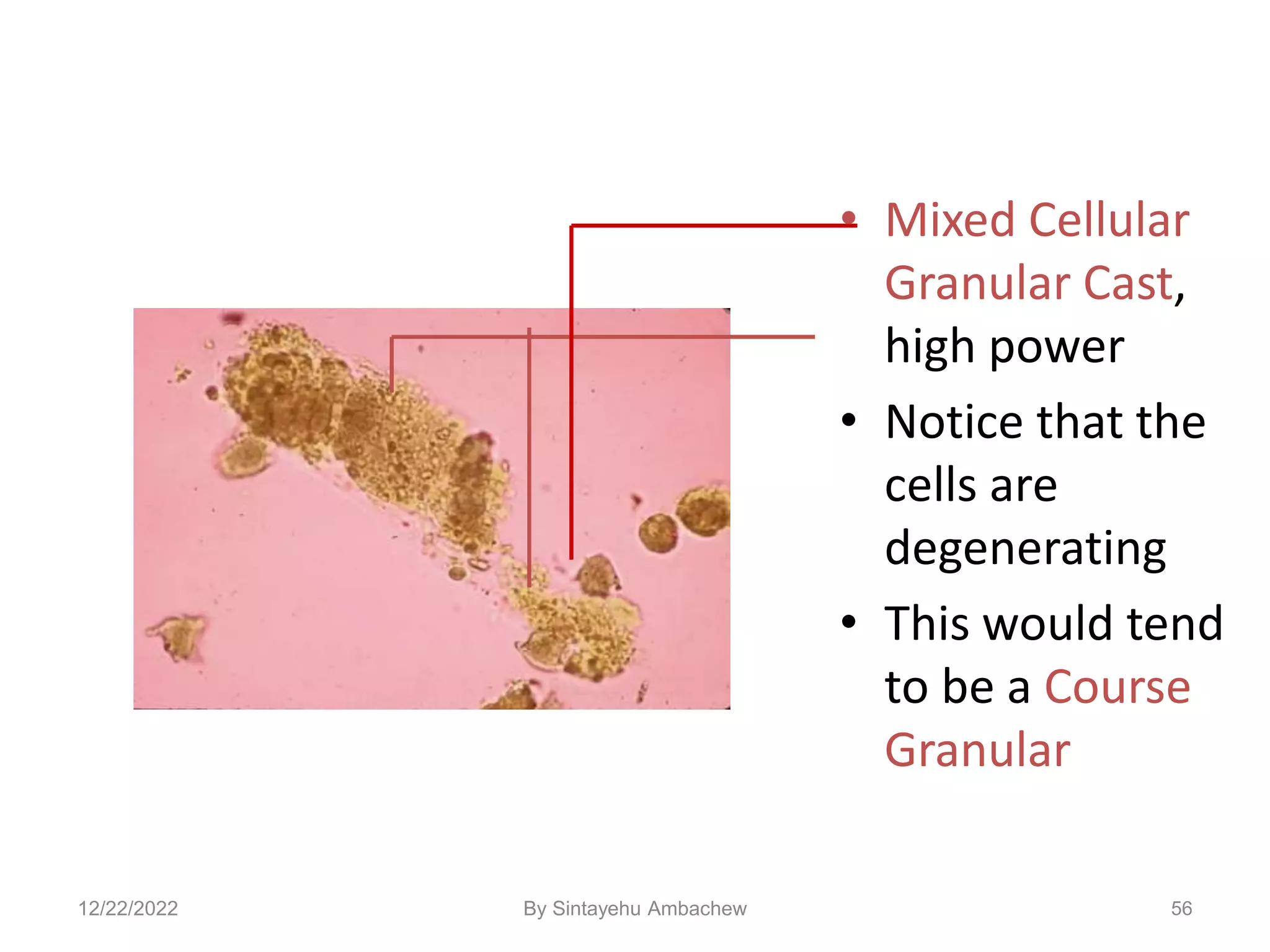 • Mixed Cellular
Granular Cast,
high power
• Notice that the
cells are
degenerating
• This would tend
to be a Course
Granular
56
12/22/2022 By Sintayehu Ambachew
 