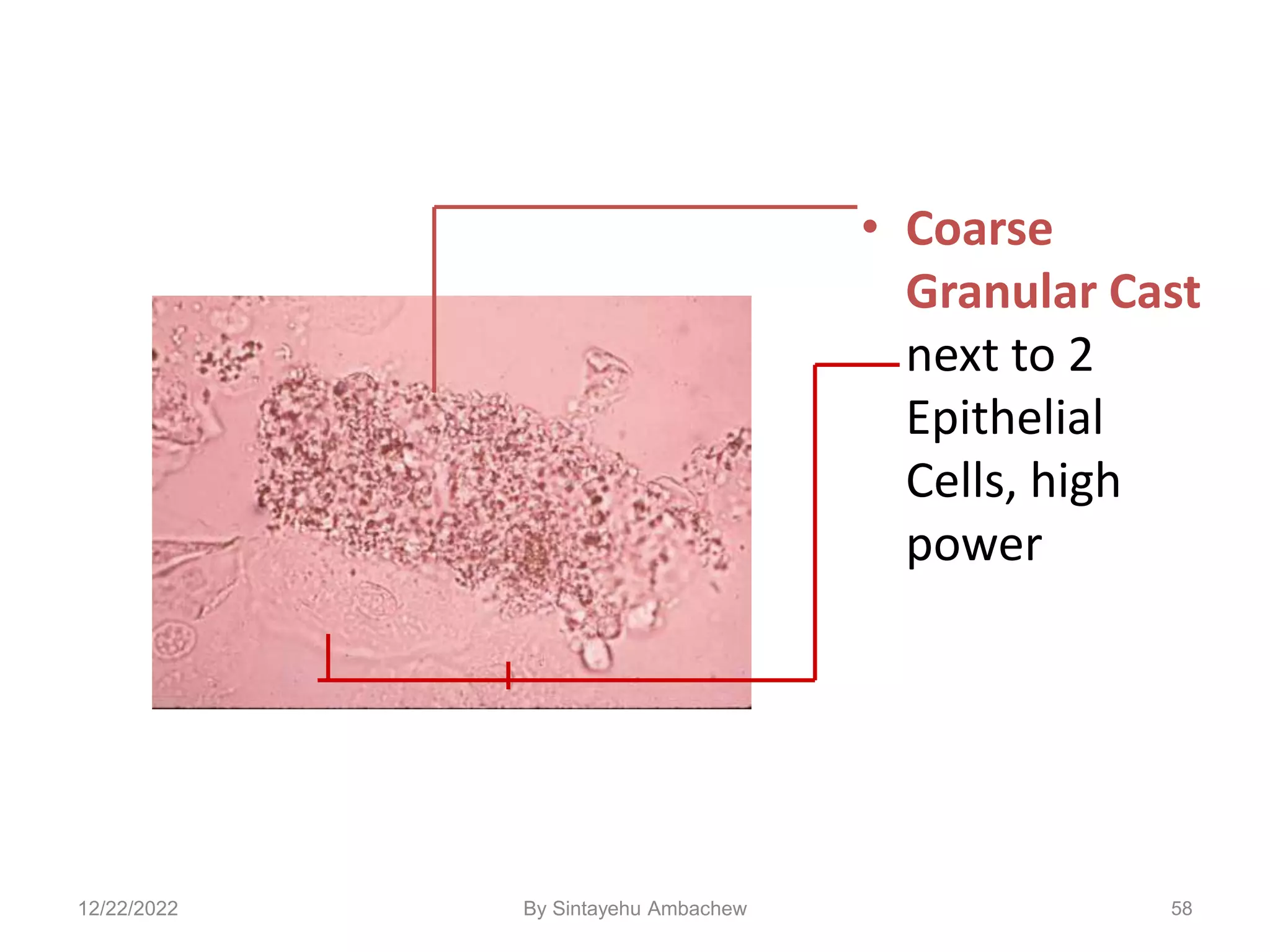 • Coarse
Granular Cast
next to 2
Epithelial
Cells, high
power
58
12/22/2022 By Sintayehu Ambachew
 