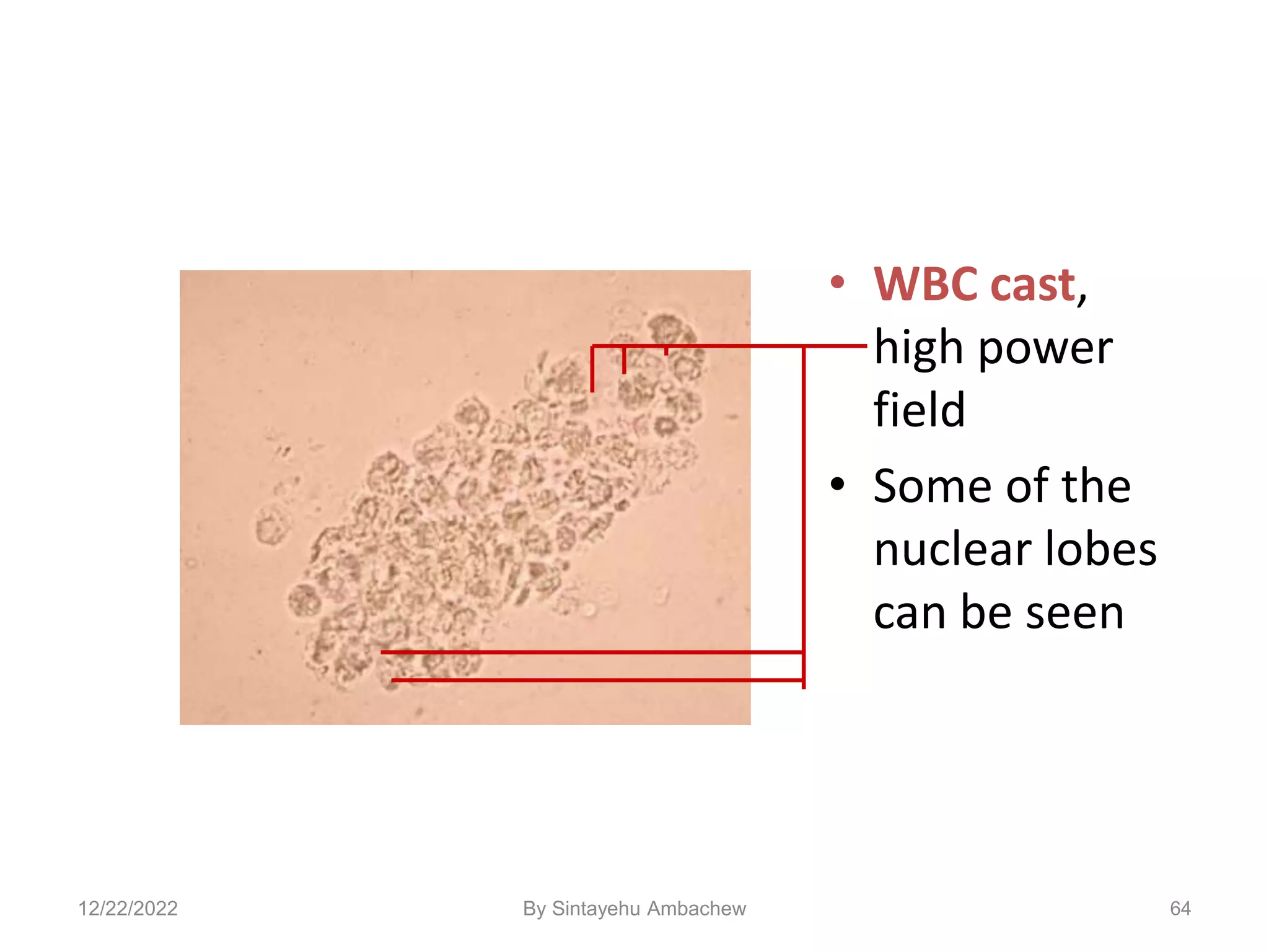 • WBC cast,
high power
field
• Some of the
nuclear lobes
can be seen
64
12/22/2022 By Sintayehu Ambachew
 