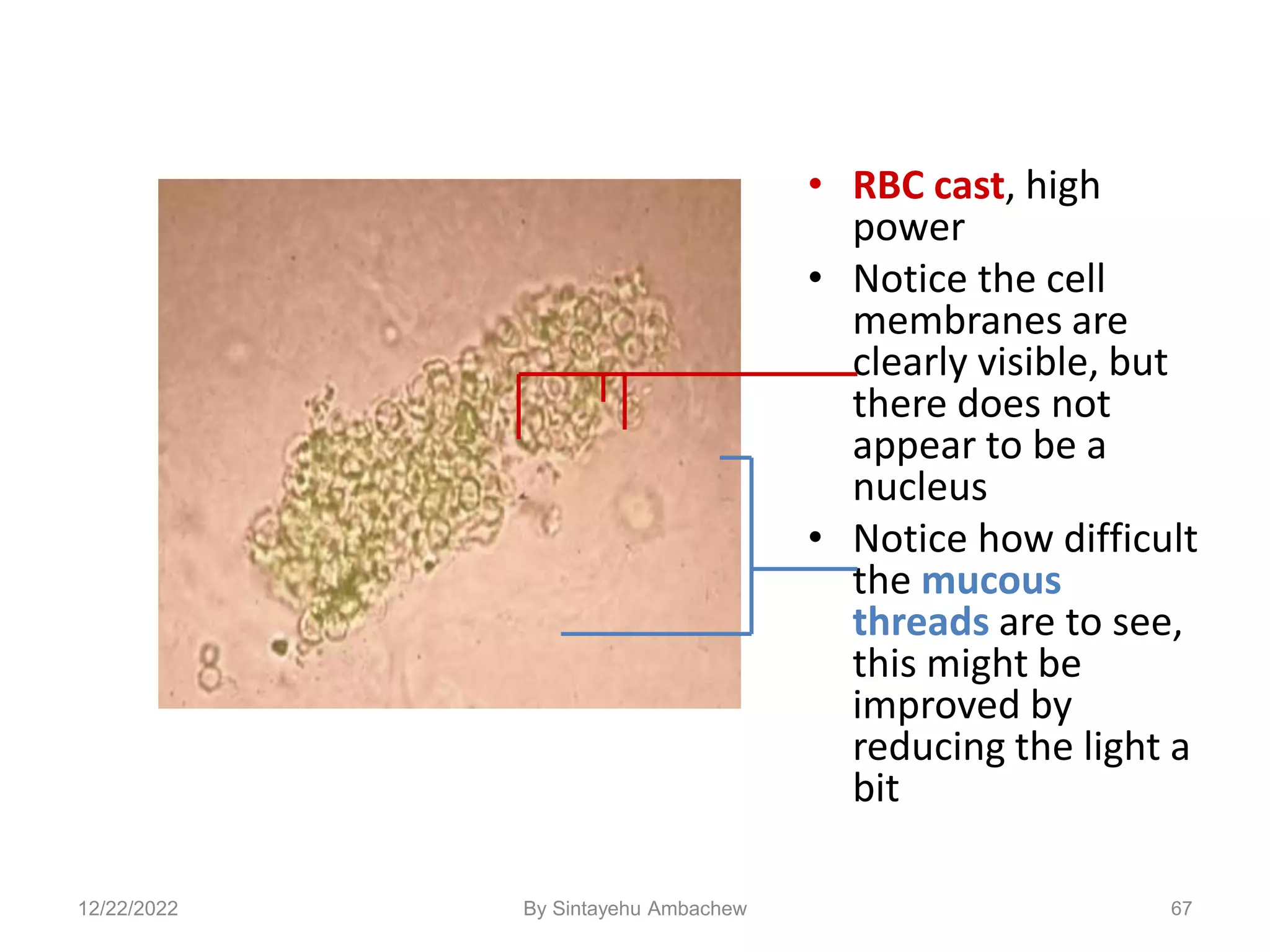 • RBC cast, high
power
• Notice the cell
membranes are
clearly visible, but
there does not
appear to be a
nucleus
• Notice how difficult
the mucous
threads are to see,
this might be
improved by
reducing the light a
bit
67
12/22/2022 By Sintayehu Ambachew
 