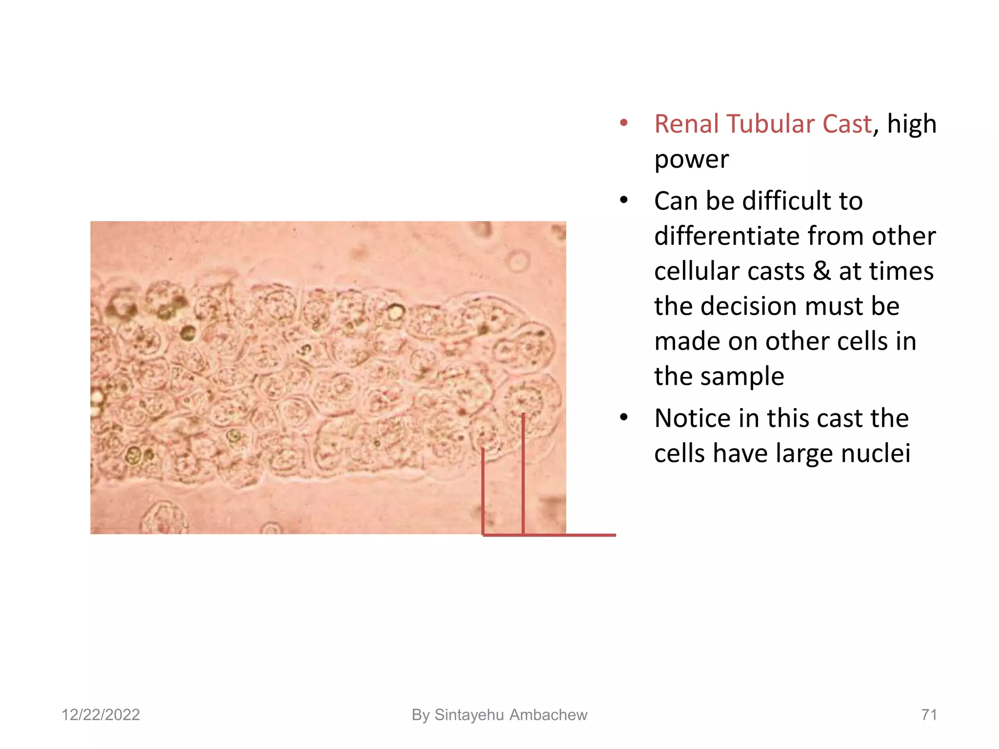 • Renal Tubular Cast, high
power
• Can be difficult to
differentiate from other
cellular casts & at times
the decision must be
made on other cells in
the sample
• Notice in this cast the
cells have large nuclei
71
12/22/2022 By Sintayehu Ambachew
 