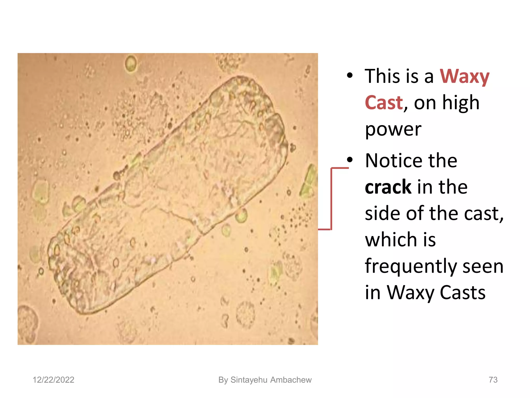 • This is a Waxy
Cast, on high
power
• Notice the
crack in the
side of the cast,
which is
frequently seen
in Waxy Casts
73
12/22/2022 By Sintayehu Ambachew
 
