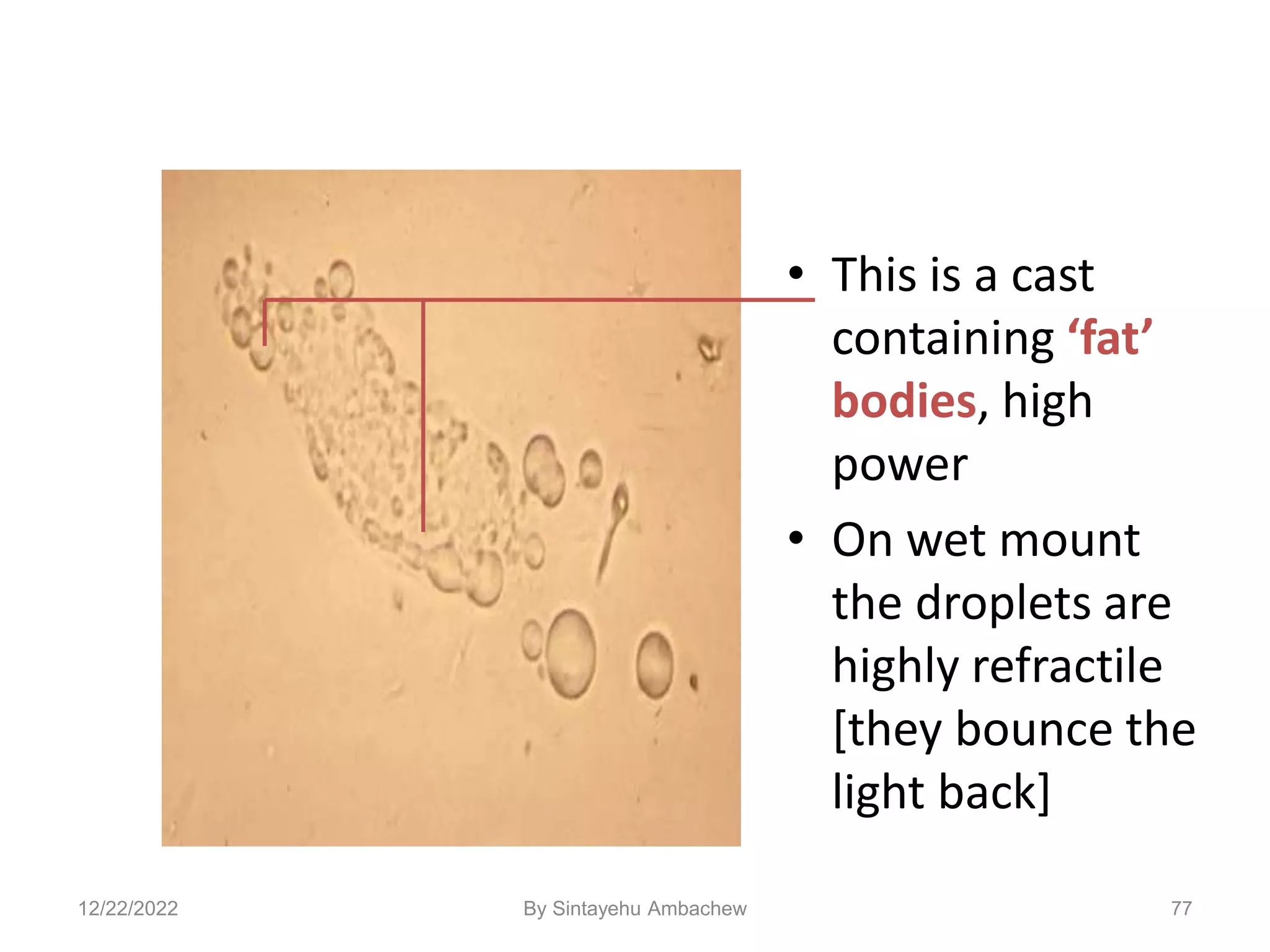 • This is a cast
containing ‘fat’
bodies, high
power
• On wet mount
the droplets are
highly refractile
[they bounce the
light back]
77
12/22/2022 By Sintayehu Ambachew
 