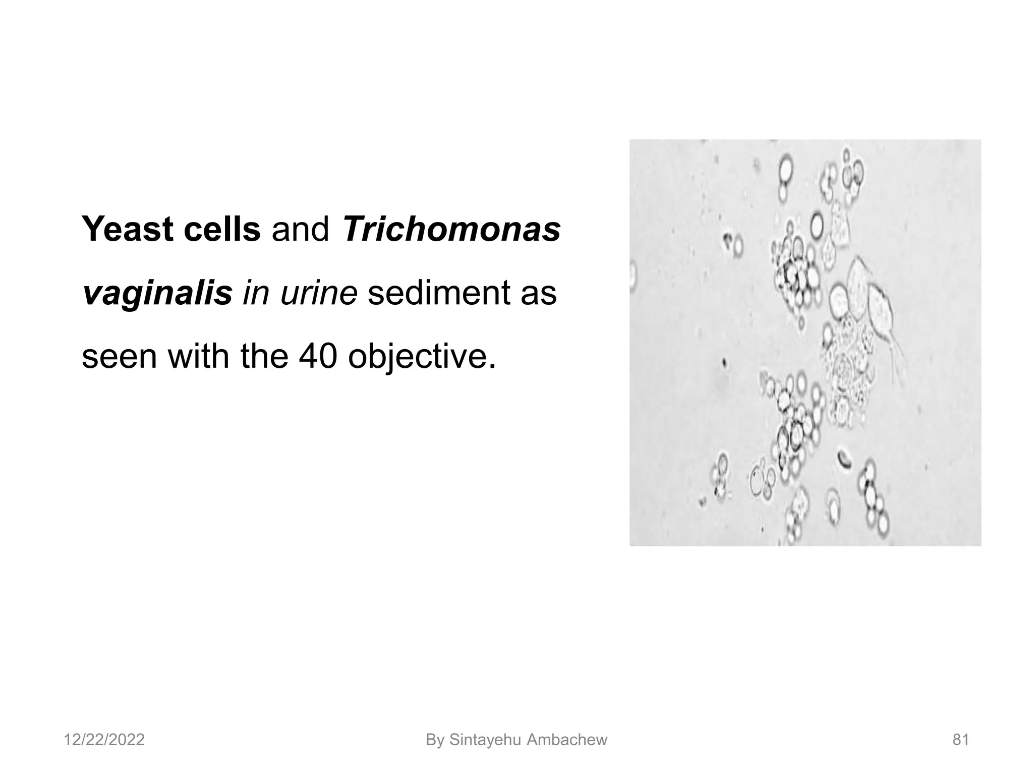 81
Yeast cells and Trichomonas
vaginalis in urine sediment as
seen with the 40 objective.
12/22/2022 By Sintayehu Ambachew
 