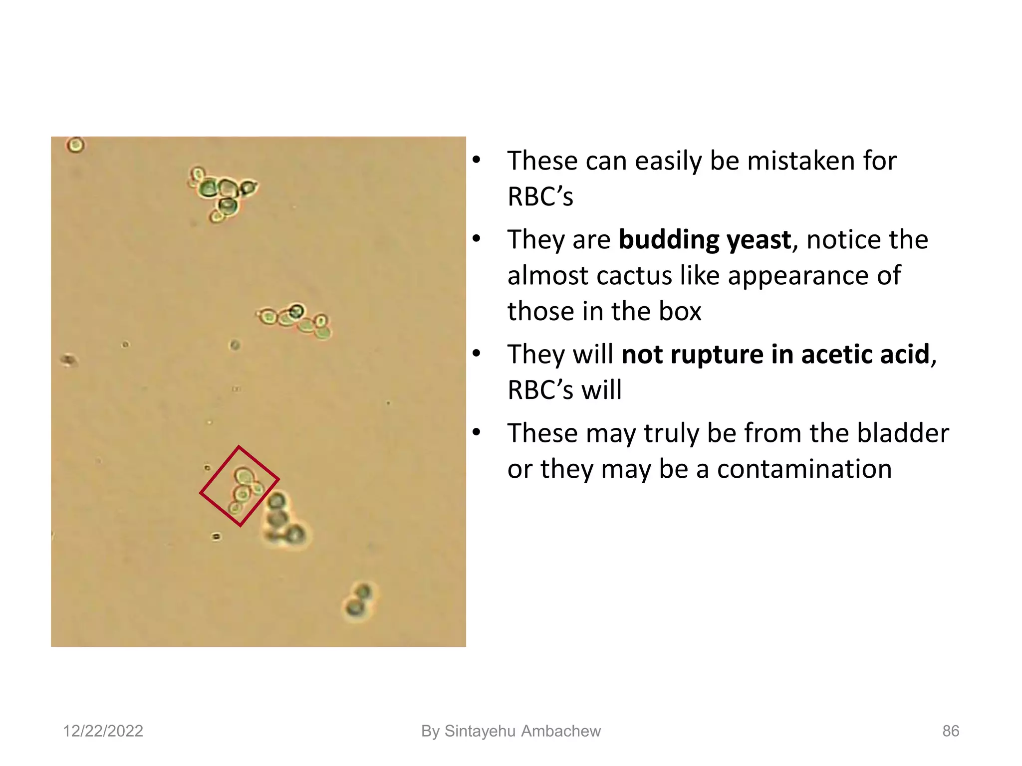 86
• These can easily be mistaken for
RBC’s
• They are budding yeast, notice the
almost cactus like appearance of
those in the box
• They will not rupture in acetic acid,
RBC’s will
• These may truly be from the bladder
or they may be a contamination
12/22/2022 By Sintayehu Ambachew
 