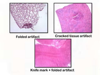 Folded artifact         Cracked tissue artifact




         Knife mark + folded artifact
 
