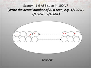 Scanty - 1-9 AFB seen in 100 VF 
(Write the actual number of AFB seen, e.g. 1/100VF, 
3/100VF…9/100VF) 
7/100VF 
 
