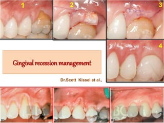 Gingival recession management
1 2 3
4
Dr.Scott Kissel et al.,
 