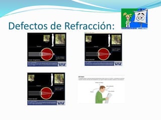 Defectos de Refracción:
 