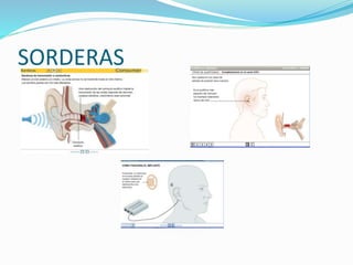 SORDERAS
 